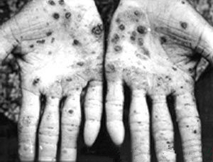 地下水砷污染－手症状